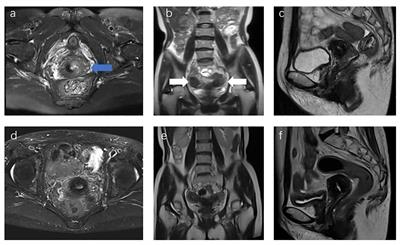 Case report: Cervical brachytherapy technique for locally advanced cervical cancer in a patient with complete bicorporeal uterus